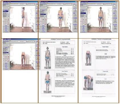 Diagnóstico Postural Computadorizada